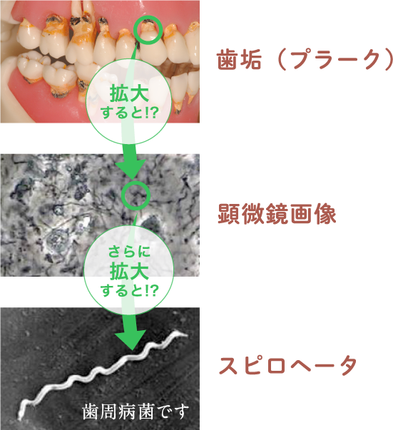 歯垢（プラーク） 顕微鏡画像 スピロヘータ