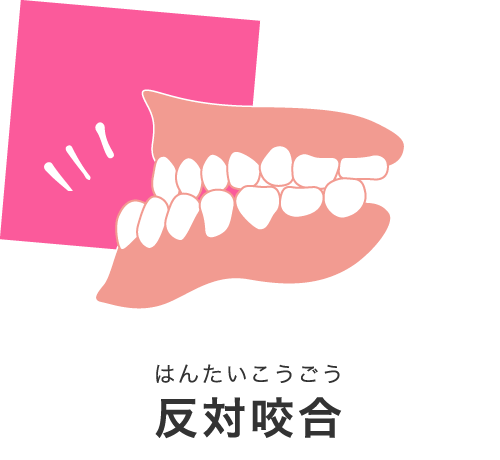 反対咬合