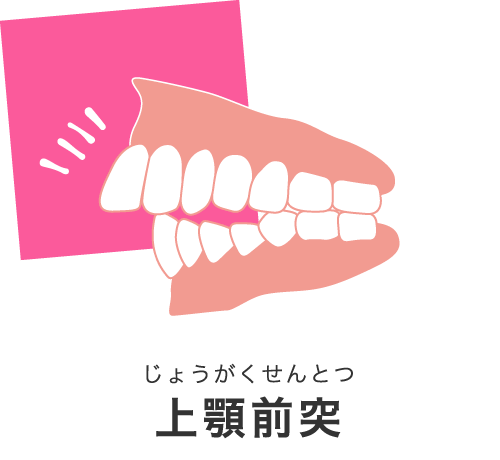 上顎前突